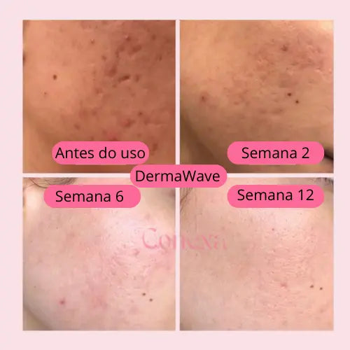 DermaWave: Tecnologia de Alta Frequência para Pele e Cabelo 4 em 1